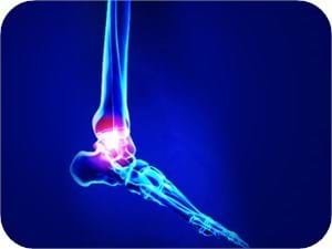 Sprained Lateral Ankle Treatment Physiotherapy Best Care Melbourne