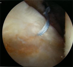 Physiotherapy Hip Labral Tears