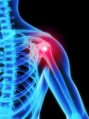 Shoulder Bursiitis Physiotherapy